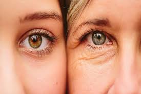 Under-Eye Wrinkles